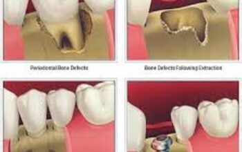 Best Periodontal bone grafts clinic in Dubai UAE