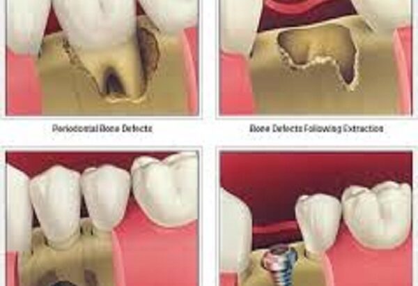 Best Periodontal bone grafts clinic in Dubai UAE